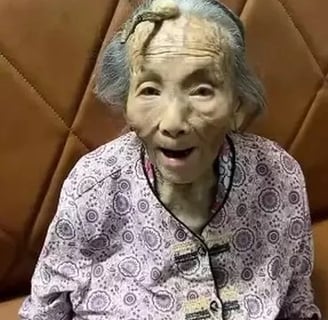 idosa chinesa de 107 anos com chifre na testa osso na cabeça