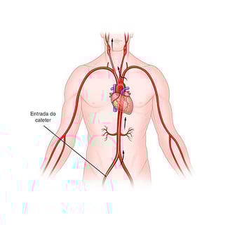 ilustração médica esquemática sobre stent