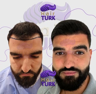 Before & after DHI hair transplant at HairTurk: bald man to full hair, smiling