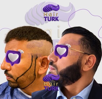 Before & after beard transplant at HairTurk: bald man to full beard man, smiling.