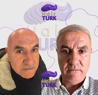 Before & after hair transplant at HairTurk: elderly bald man to full hair, smiling