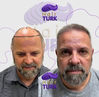 Before & after FUE hair transplant at HairTurk: elderly bald man to full hair, smiling