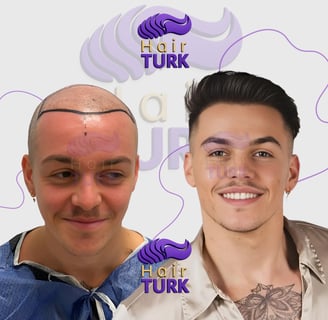Before & after FUE hair transplant at HairTurk: bald man to full hair, smiling.