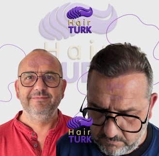 Antes y después de un trasplante capilar FUE en HairTurk: de calvo a todo pelo, sonriendo.