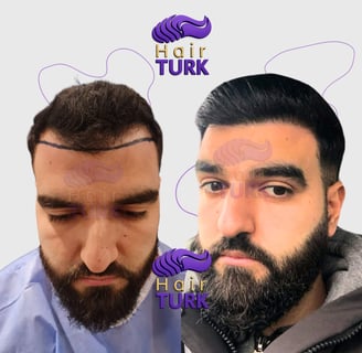 Antes y después de un DHI trasplante capilar en HairTurk: de calvo a todo pelo, sonriendo.