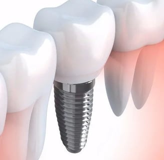 Dental Implant Clinic in Navi Mumbai | Ekdantam Dental Clinic