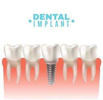 Best Dental Implants Clinic near me | Ekdantam Dental Clinic
