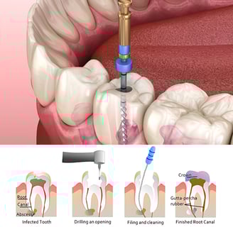 Root Canal Treatment near me |  Ekdantam Dental Clinic kopar khairane
