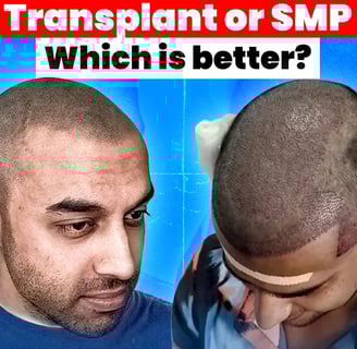 Hair transplanet vs. Scalp micropigmentation_ATRUBARBER