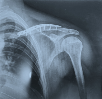 Placa para clavícula en "S"