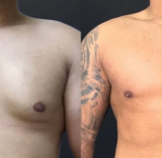 antes e depois ginecomastia 01