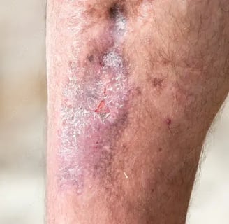 a man with a large bruise on his leg