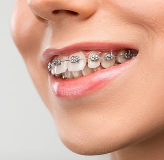 a women having braces in front tooth