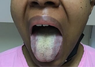 a image showing tongue with white patches