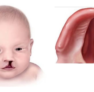 a child face with cleft lip and palate