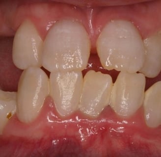 a image showing teeth with dentin dysplasia