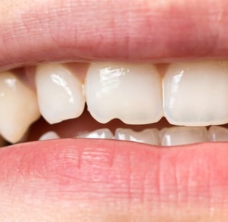 A image showing upper maxillary teeth in mouth