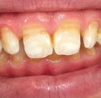 a image showing teeth with white spots in mouth