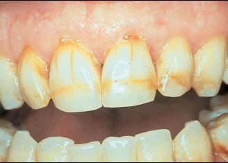 a image showing brown stains on teeth