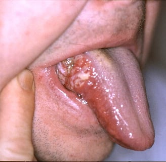 Early symptom of oral cancer in Indian women - mouth sore on tongue"