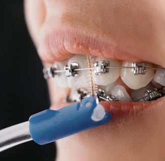 a mouth with metal braces on teeth brushed with orthodontic brushes in blue colour