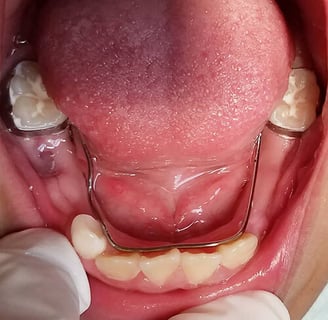 an image showing space maintainer in mouth