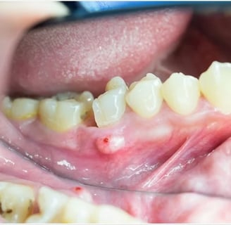 a image showing swelling around one broken molar tooth 