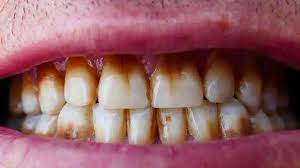 a image showing brown stains on teeth