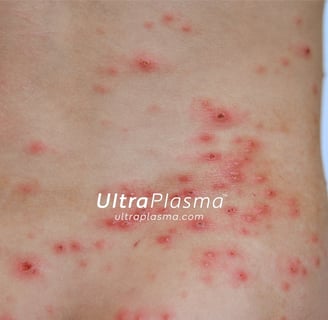 ultraplasma.com_chicken-pox-rash_treatment_su_cicegi_tedavi_ultra_plasma_ultra_plazma
