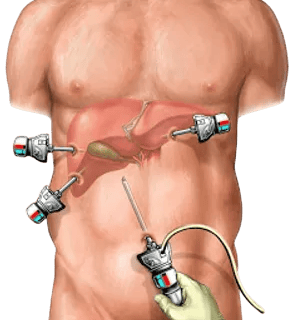 Laparoscopia para realizar colecistectomia
