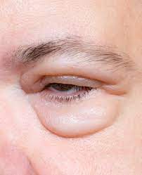 swelling under eyes
