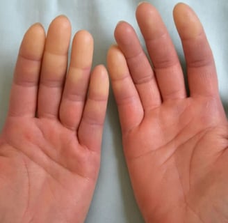 https://lasalute-clinic.ru/flebologiya/sindrom-rejno