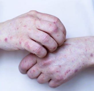 Actinic keratosis