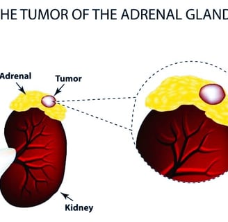 adrenal gland cancer