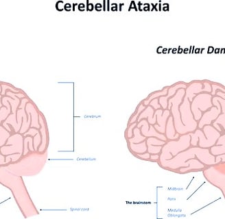 Ataxia