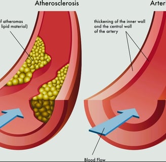 Arteriosclerosis