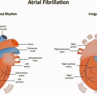 Atrial Fibrillation
