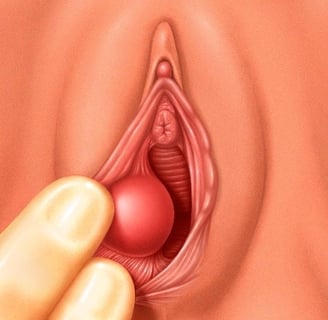 Bartholin Cysts