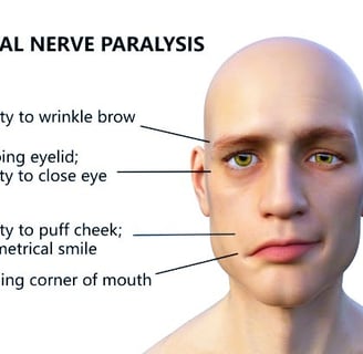bells palsy