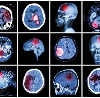 Brain Tumors