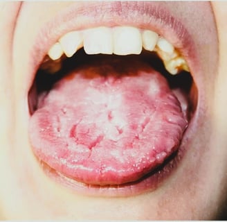 Candidiasis