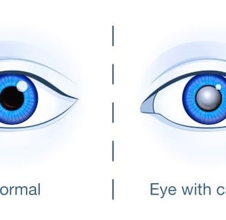 cataracts