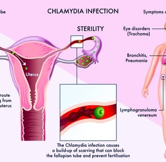 chlamydia
