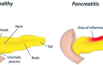 pancreatitis