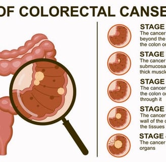 Colon Polyps