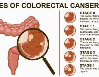 colorectal cancer