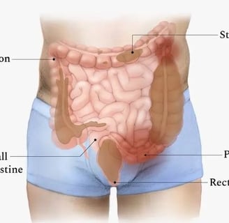 Constipation
