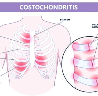 costochondritis
