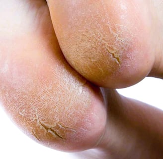 Cracked Heels