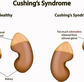 Cushing Syndrome